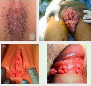 Obat kutil kelamin, obat kondiloma akuminata, obat jengger ayam